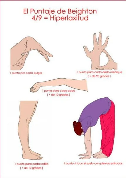Hiperlaxitud.Beighton